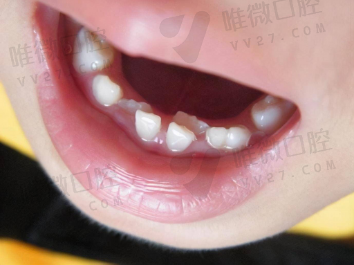 钢托义齿会伤害邻牙吗（固定义齿伤害大不大）(图1)